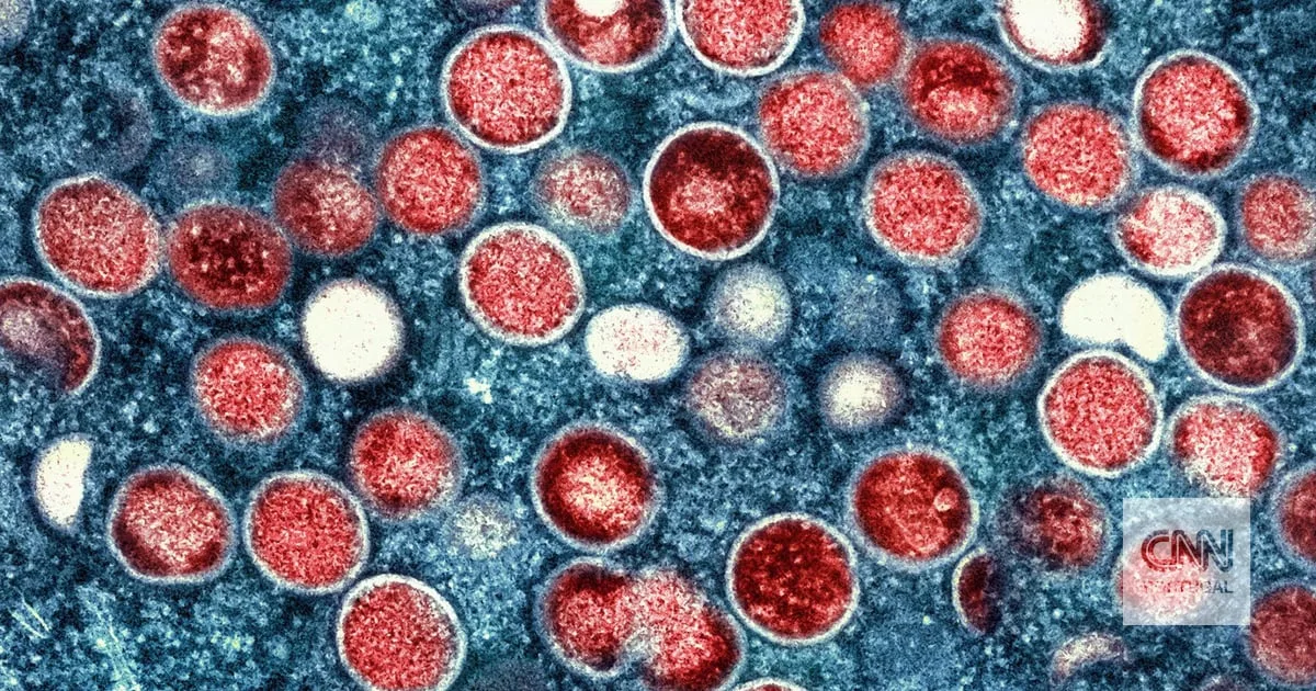 Detetado caso de mpox em menor marroquino que entrou de forma ilegal em Ceuta