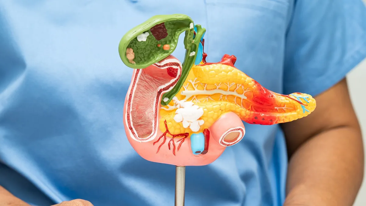 ¿Qué es el daraxonrasib, el fármaco contra el cáncer de páncreas que casi duplicó la supervivencia?
