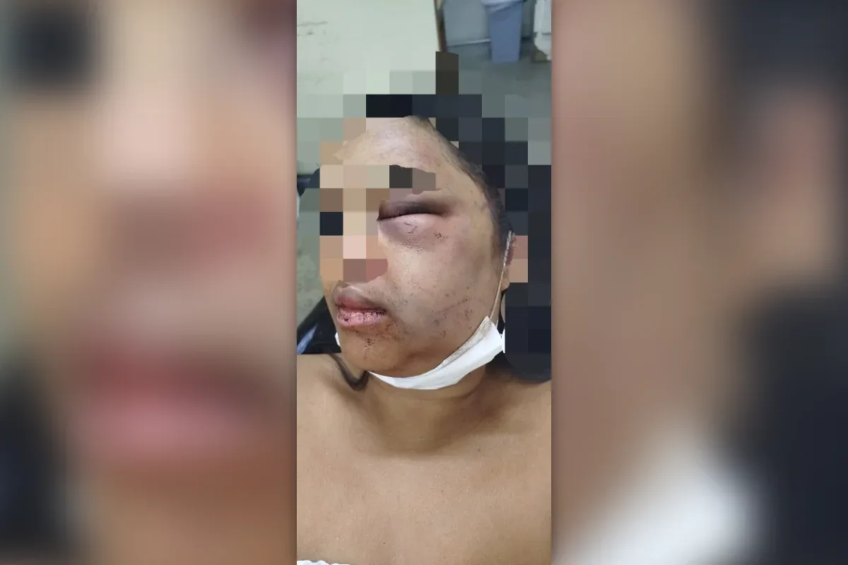 Mulher denuncia ex após ter maxilar quebrado e ficar com rosto deformado