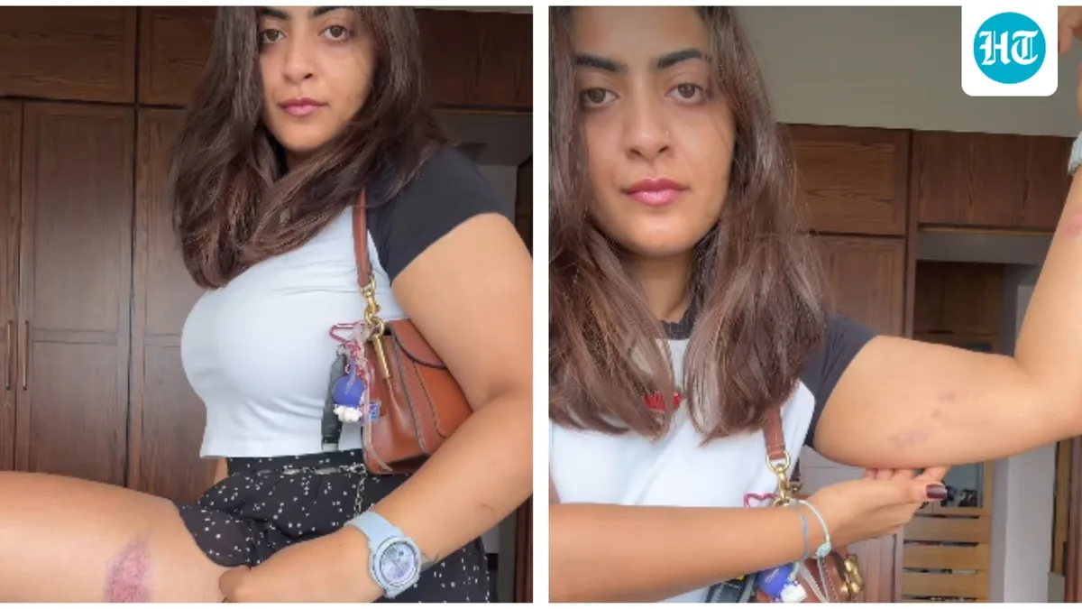Aamir Khan's niece Zayn Marie shows injury marks on her arms and legs after facing temporary detention in Mumbai during Kranti Maidan protest