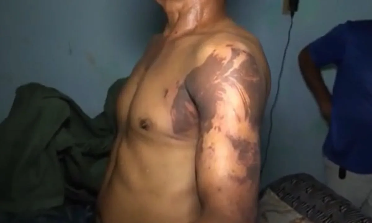 Inquérito aponta que homem suspeito de atacar três pessoas com líquido similar a ácido na Bahia agiu em legítima defesa