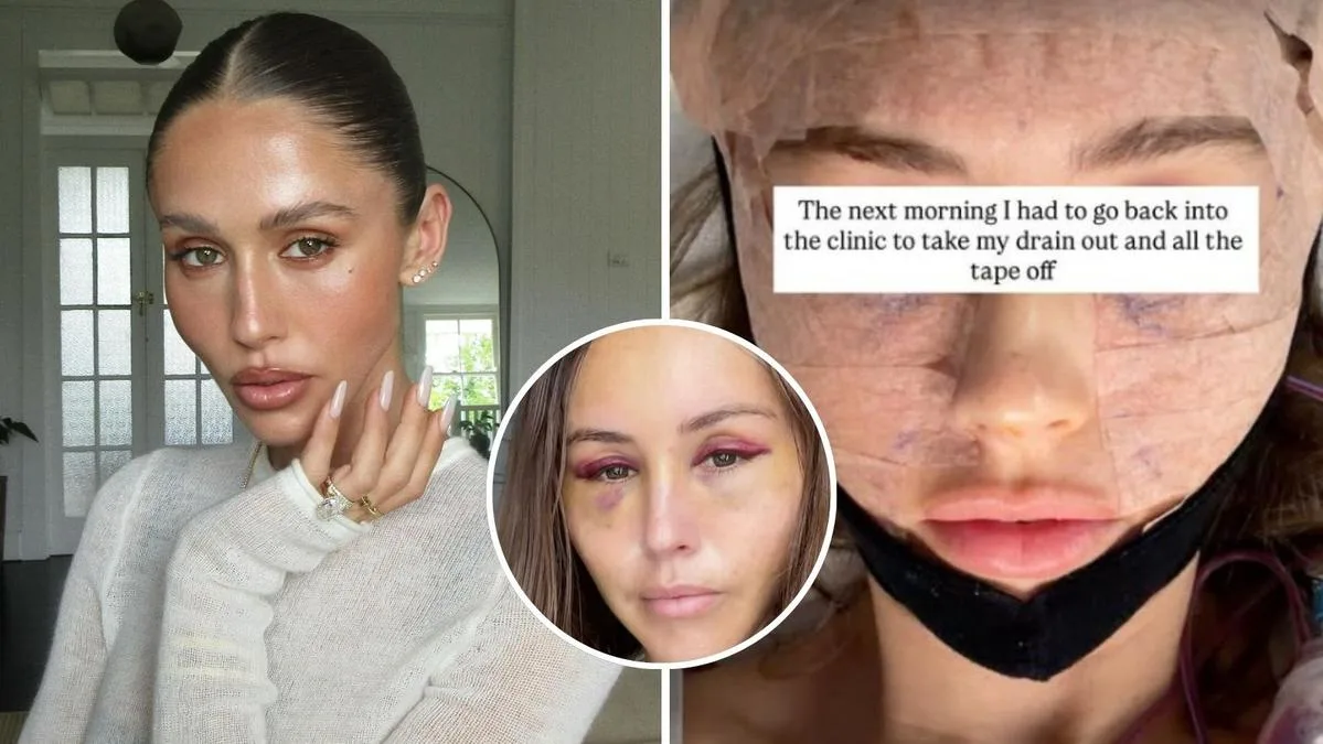 Ruby Tuesday Matthews: Influencer undergoes Korean facelift to achieve a more youthful look