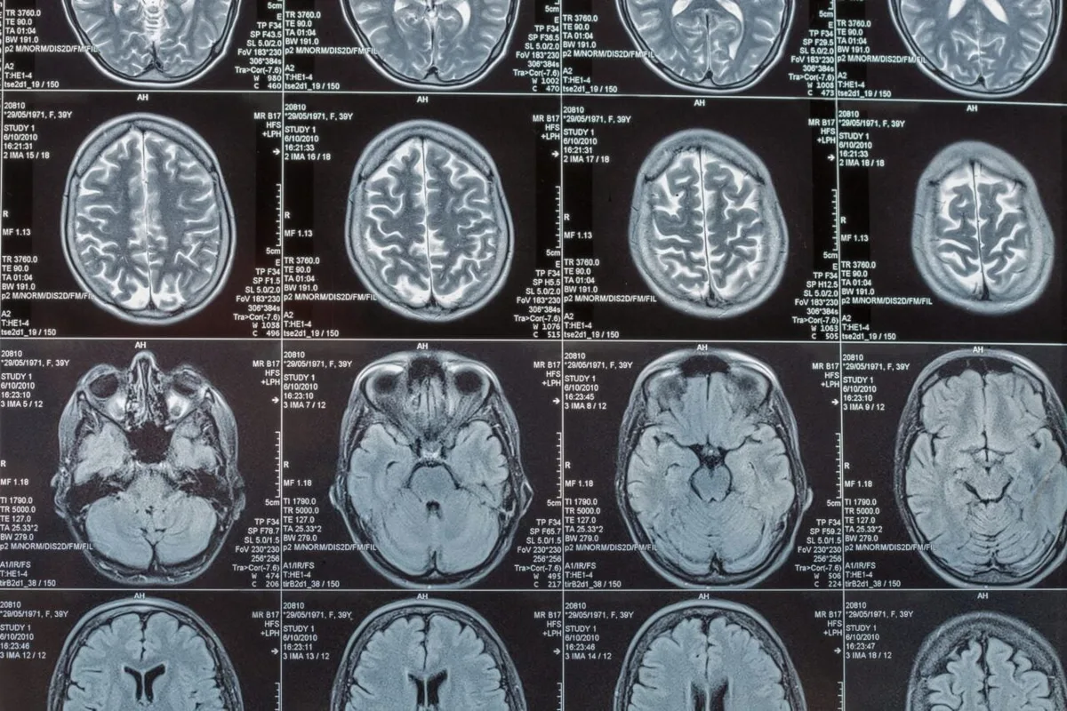 Scientists Say a Key Trigger for Alzheimer’s Damage Isn’t Even in the Brain
