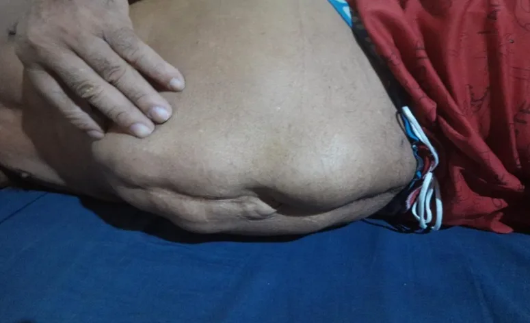 Família relata que idoso aguarda há mais de dois anos por cirurgia de hérnia em Rorainópolis