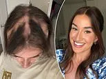 Sophie started going bald at 16 - it took 12 years before she discovered the 60-second fix that made her feel like herself again