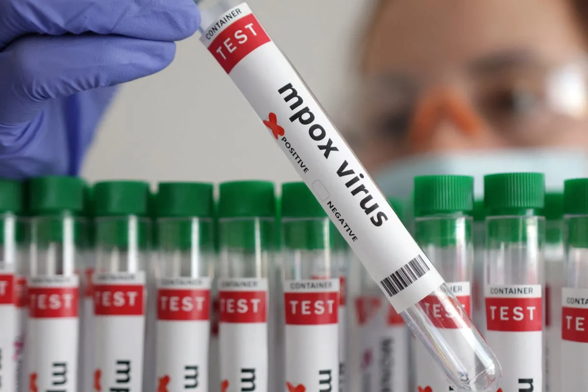 Mpox cases in SA rise to 26 as four new infections confirmed
