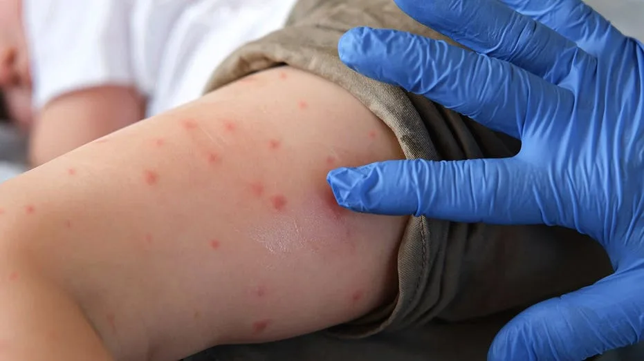Deadly measles outbreak hits Northeast as state records first deaths in 35 years