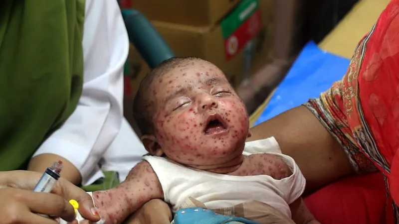 World’s worst measles outbreak a ‘warning’ to other nations