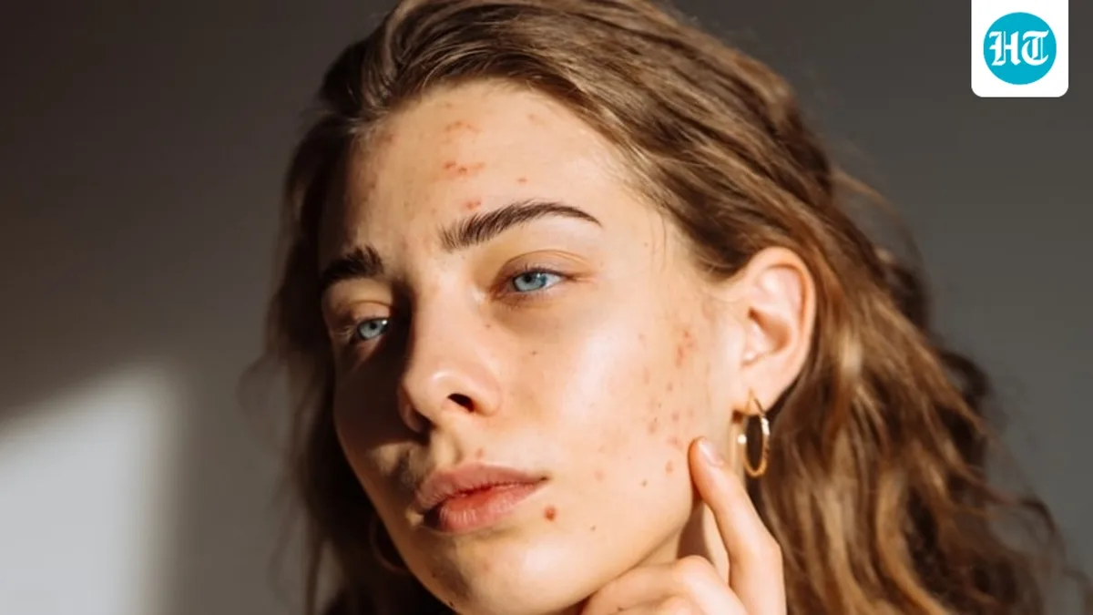 Fungal vs bacterial acne: Dermatologist explains how to identify your monsoon breakout