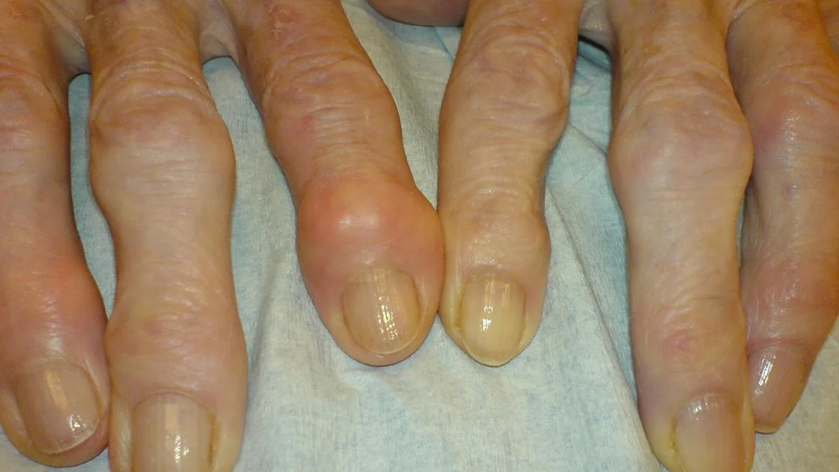 Health Quiz: On arthritis