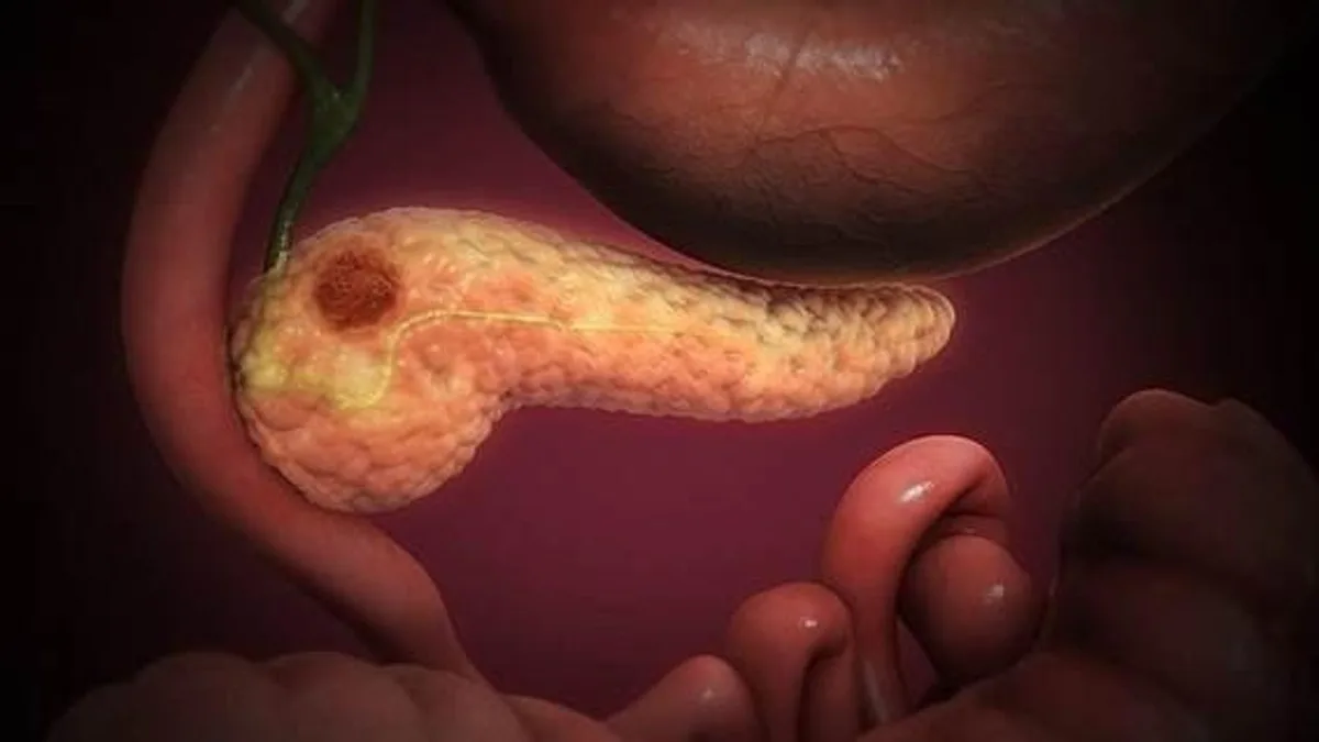 Qué es daraxonrasib, la droga aprobada en Estados Unidos que promete transformar el tratamiento del cáncer de páncreas