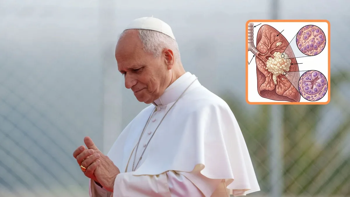Qué es un adenocarcinoma pulmonar, enfermedad detectada al papa León XIV: experto analizó qué viene para el sumo pontífice