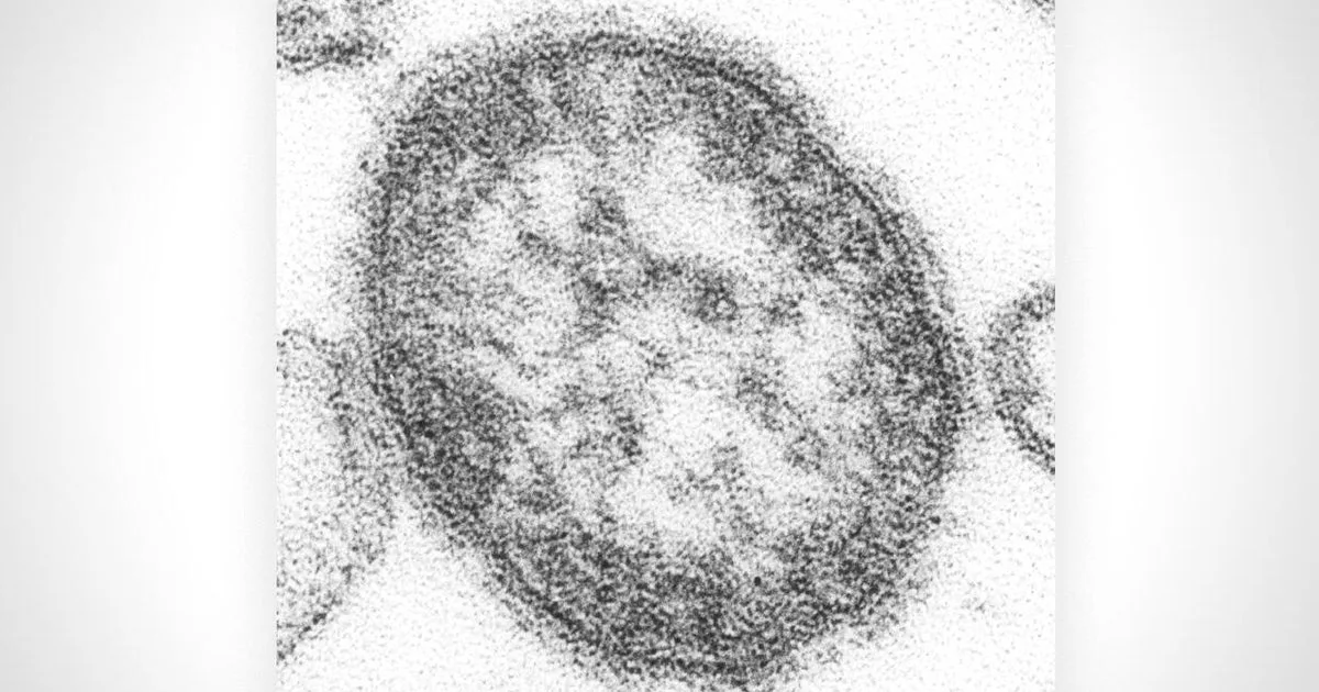 Pennsylvania woman dies of measles complications, Jefferson County Coroner reports