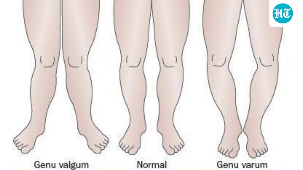 Bow legs vs knock knees: Paediatric orthopaedic Dr Somesh Virmani explains leg alignment in children, when to seek help