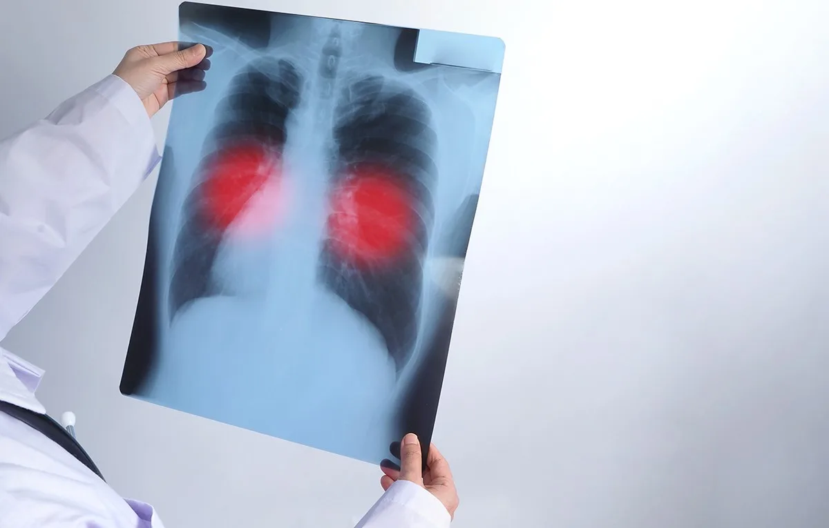 Mortes por tuberculose caem 14,8% no Amazonas; idosos concentram um terço dos óbitos