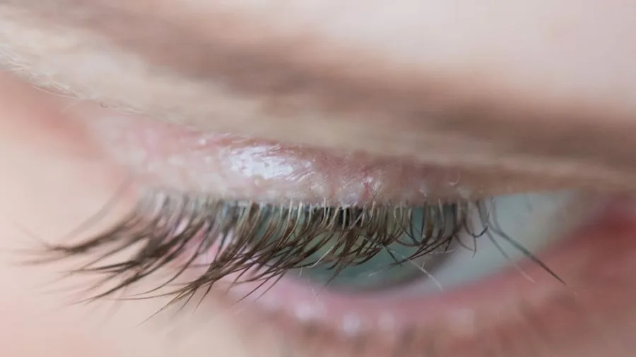 Entzündung am Auge: Milben am Auge: Wie man den Befall erkennt und bekämpft