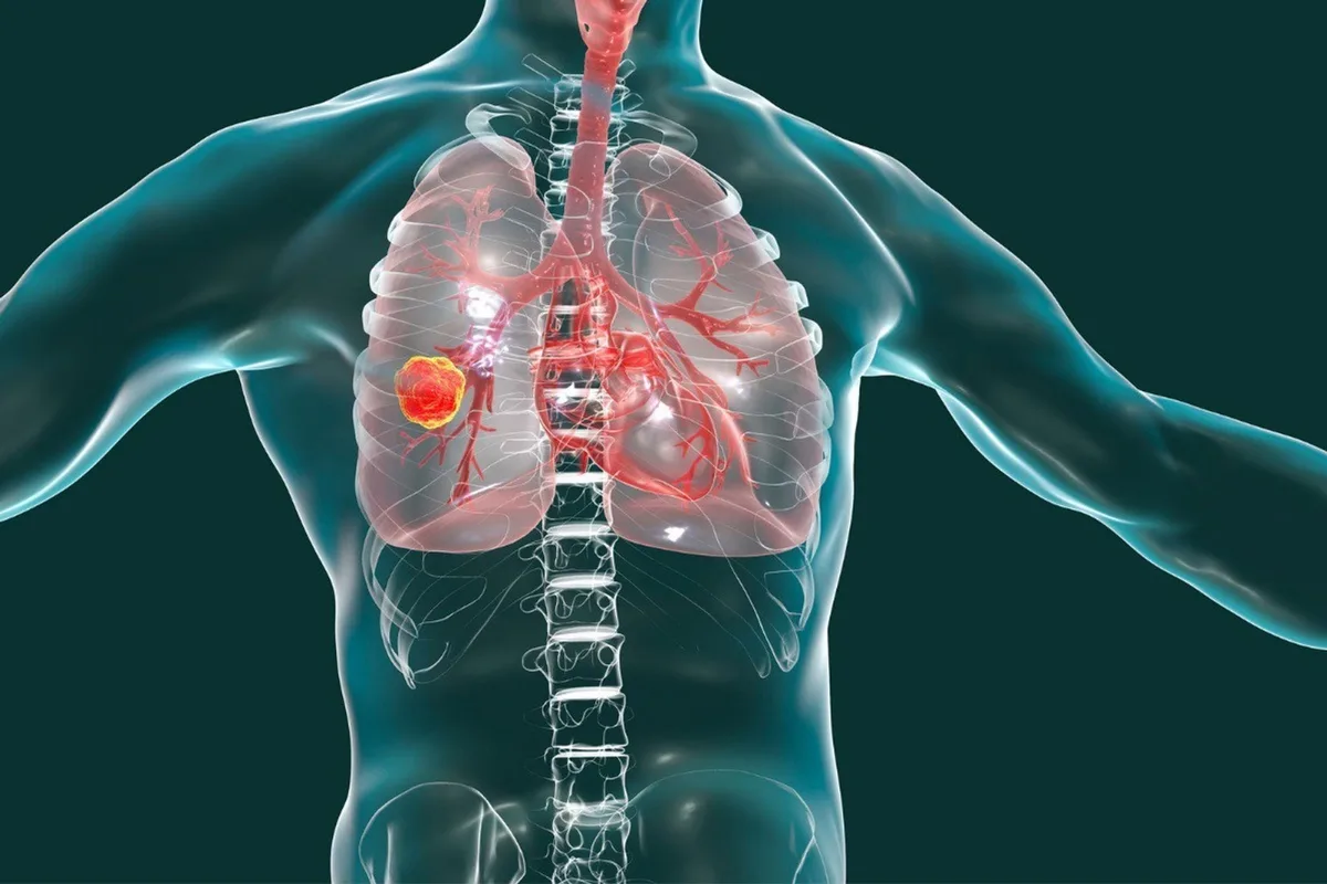La salud del Papa: qué es un adenocarcinoma pulmonar, cómo se trata y qué pronóstico tiene