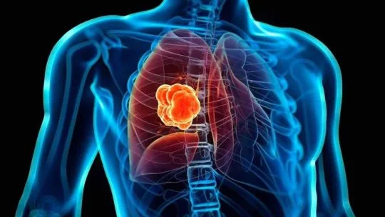 Qué son los nódulos pulmonares, la lesión por la que será operado el papa León XIV
