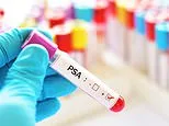 The £395 prostate cancer test that gives a more accurate diagnosis, who should consider paying for it - and why it's not available on the NHS