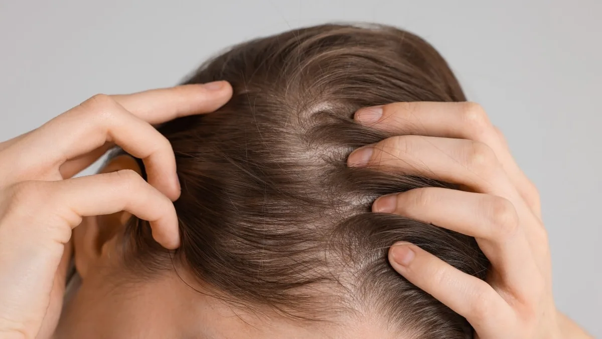 Arthritis drug restores 100% of hair on some patients with severe alopecia in global trial