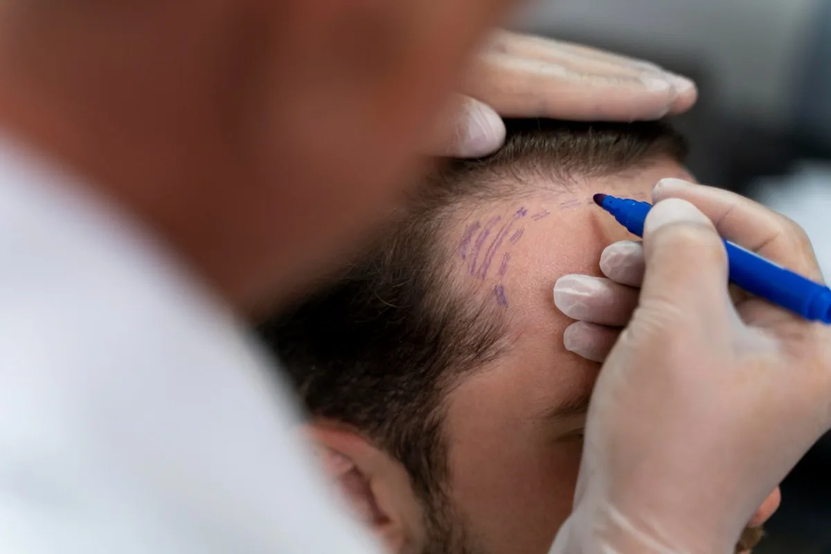 Transplante capilar evoluiu; risco agora é tratar uma cirurgia sofisticada como um procedimento simples