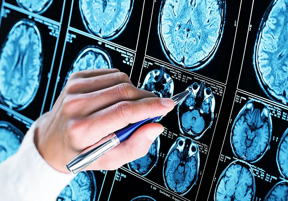 Realizan con éxito en Londres la primera cirugía cerebral del mundo asistida por inteligencia artificial en tiempo real