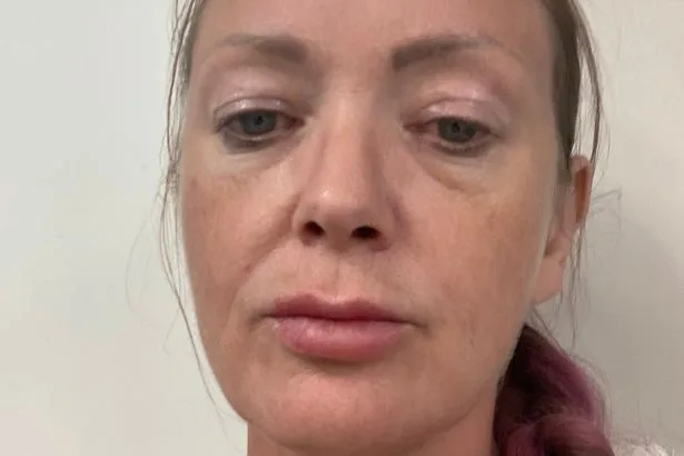 Mum whose jaw opens less than width of 5p coin fears NHS is 'leaving her to die'
