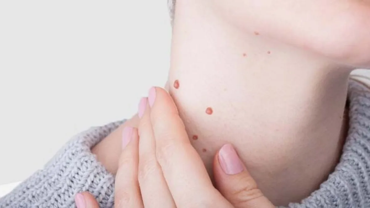 Eliminación de verrugas en el cuello, manos y cara sin quemaduras y cicatrices permanentes