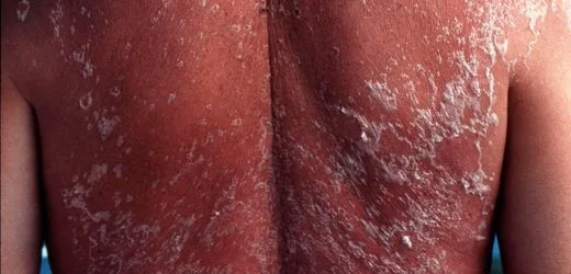 UV-Strahlung: Warum mehr Sonne in Mitteleuropa zum Problem für die Haut wird