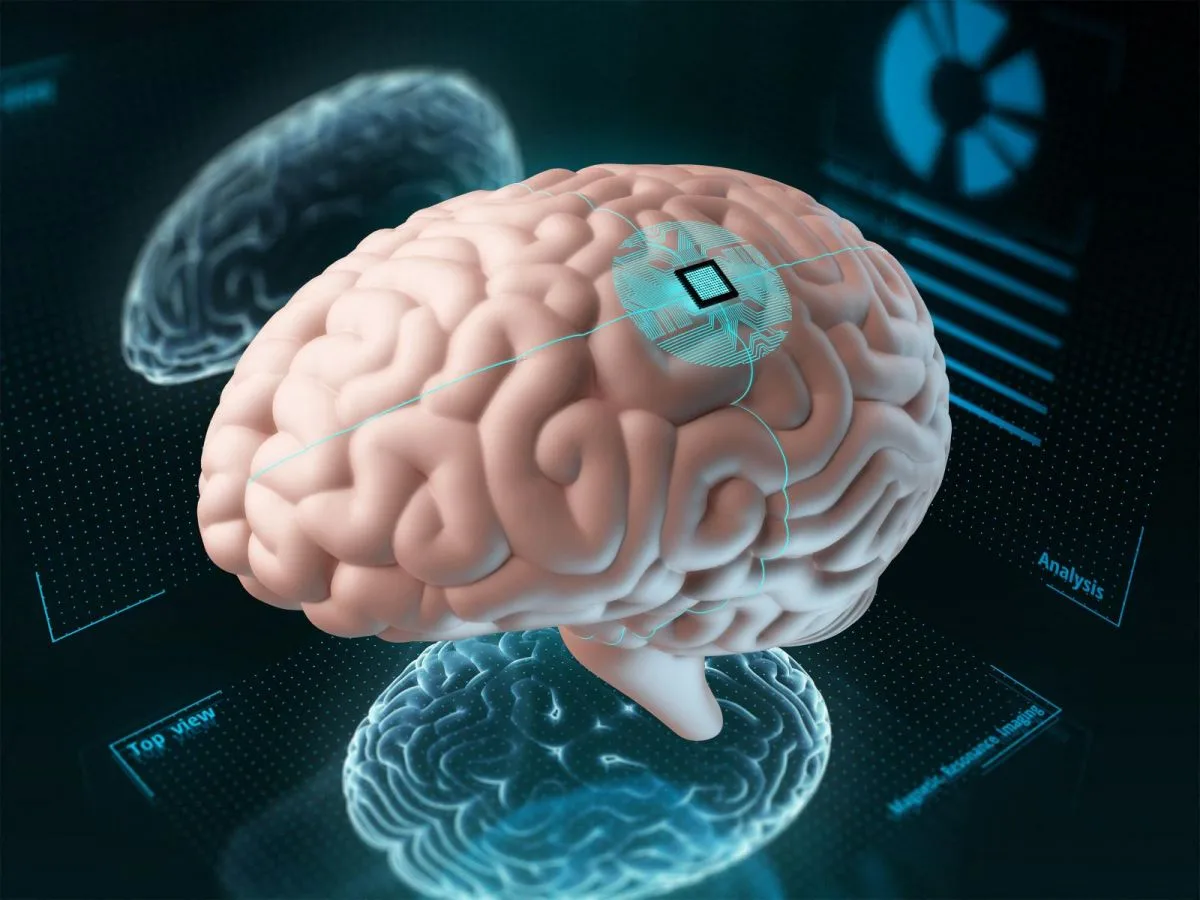 Un implant cérébral parvient à décoder la parole et le mouvement des personnes paralysées