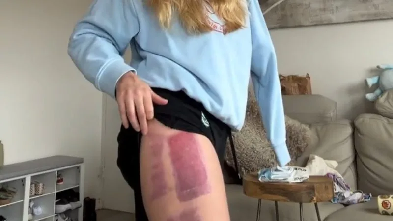 'Devastated' shark attack survivor said skin graft has failed