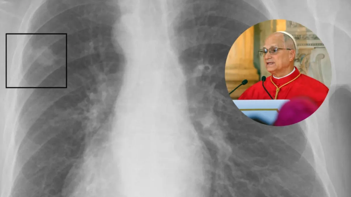 Qué es un nódulo pulmonar, la lesión por la que el Papa León XIV tiene que pasar por quirófano
