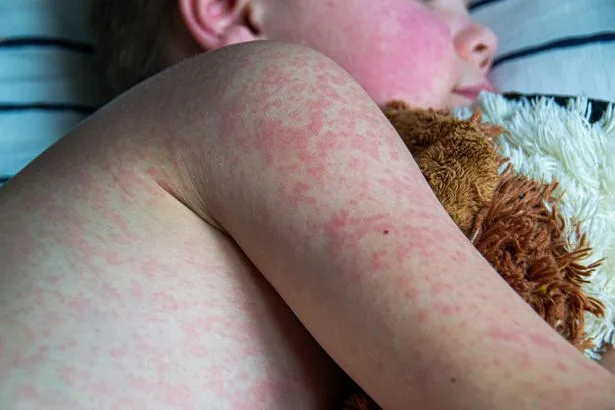 Measles cases soar after ten-year fall in vaccines - see numbers in your area