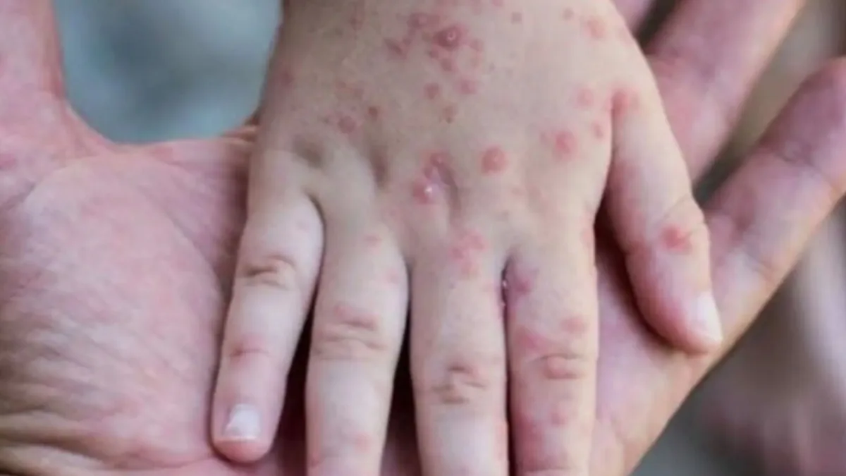 Sarampión en Perú: Minsa emite alerta epidemiológica por incremento de casos y refuerza medidas de prevención