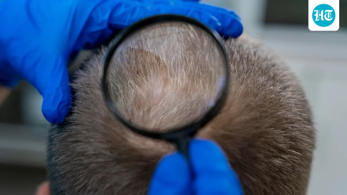 Noticed a sudden bald patch? Dermatologist identifies 8 possible reasons, from stress to fungal infection