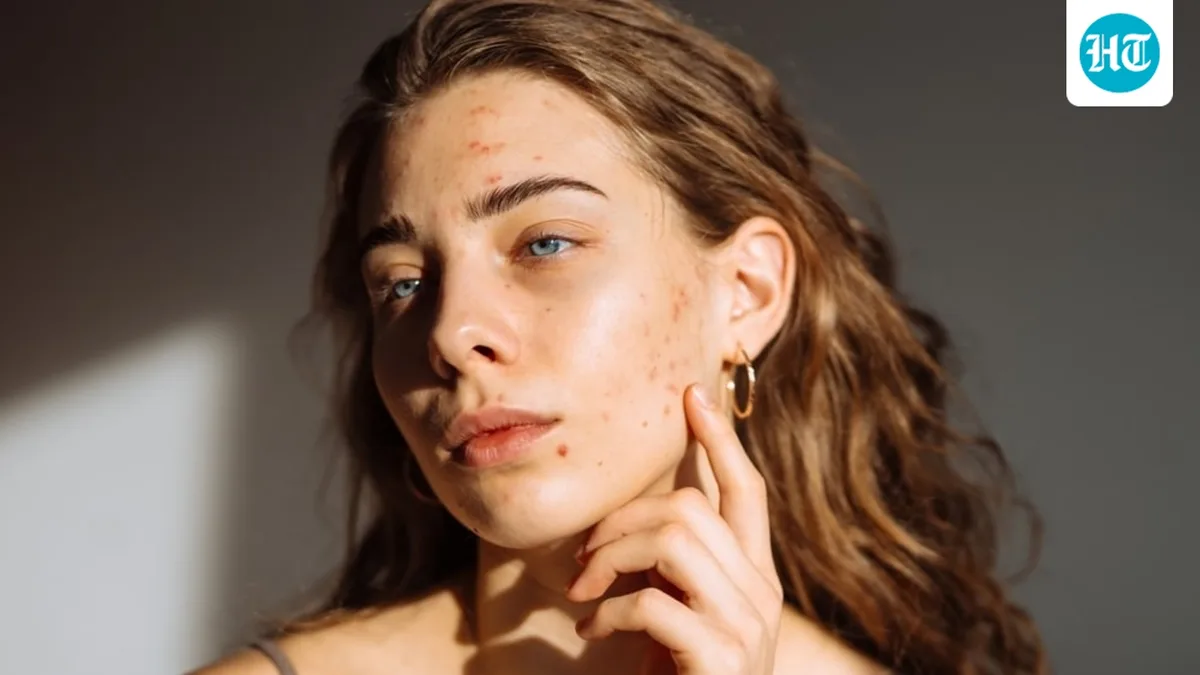 Why does your acne keep coming back? Dermatologist lists 5 daily triggers, from dirty pillowcase to unclean phone