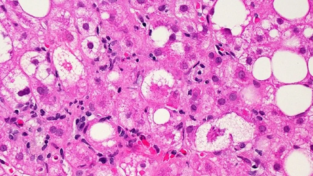 Doctors, liver specialist team up to better fight hepatitis in Alberta