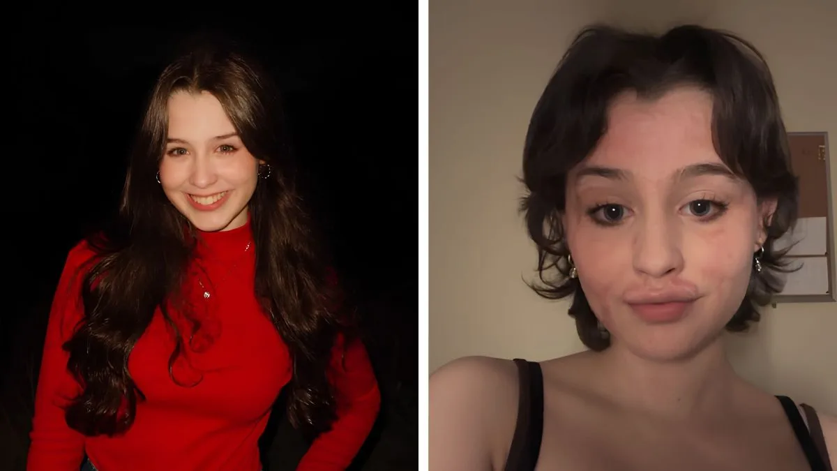 ‘Eu não vejo só cicatrizes’: jovem de 20 anos transforma trauma após ter 20% do corpo queimado em superação