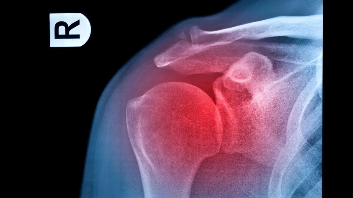 Orthopädie: Warum es bei Schulterschmerz so wichtig ist, die genaue Ursache zu kennen