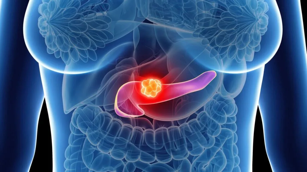 Cancro do pâncreas: medicamento aprovado nos EUA pode chegar à Europa em poucos meses