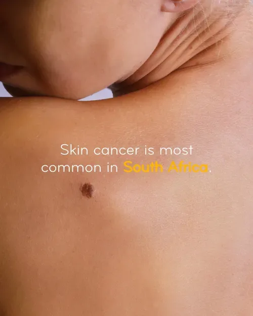 Catch the rays, not the risk: Free skin cancer screenings this September