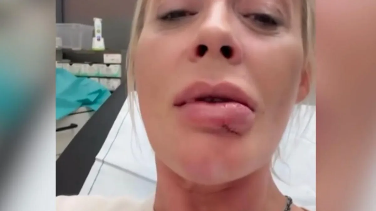 "Wie Quasimodo": Cora Schumacher meldet sich mit dicker Lippe aus Notaufnahme
