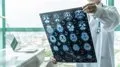 La epilepsia infantil se asocia con un menor nivel educativo a largo plazo