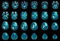 Glioma: descubren que la biología de este agresivo cáncer cerebral cambia alrededor de los 26 años
