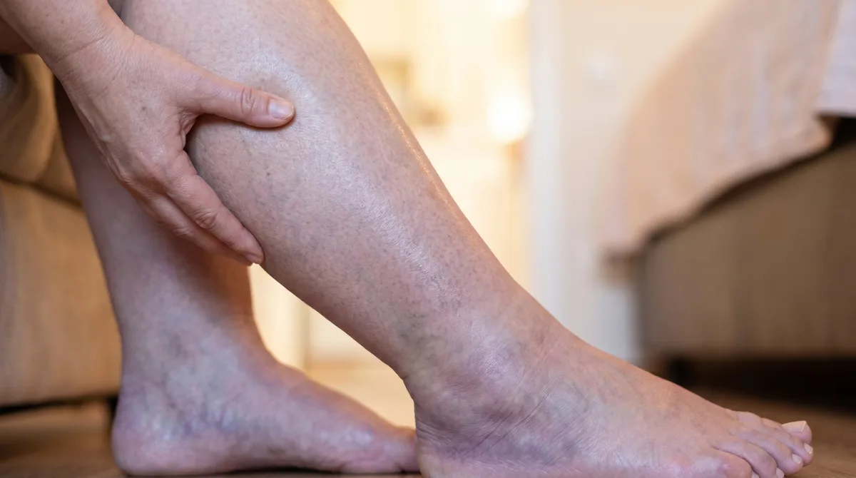 Una pierna inflamada, falta de aire o dolor en el pecho: los síntomas que pueden indicar una trombosis y exigen atención urgente