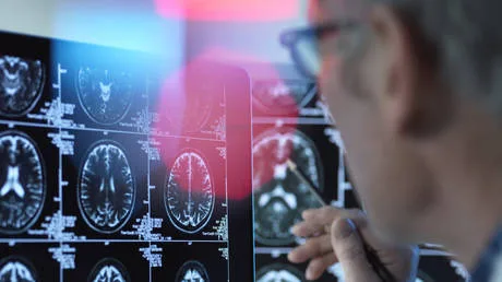 Russian doctors pioneer new Alzheimer’s treatment strategy