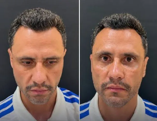Harmonização facial: Cleitinho faz procedimento um dia depois de ser eleito governador de MG