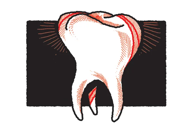Após perda de dente, enxerto ósseo devolve capacidade de comer e sorrir