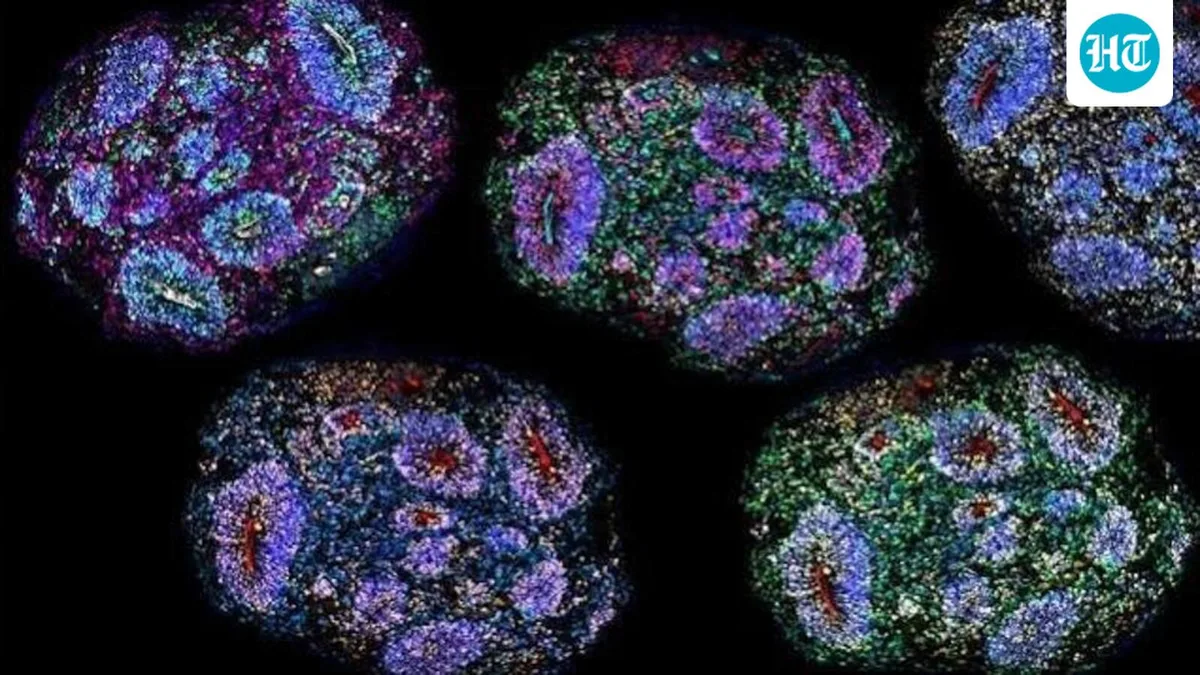 Supreme Court orders autism patients on stem cell therapy to register on Centre’s portal
