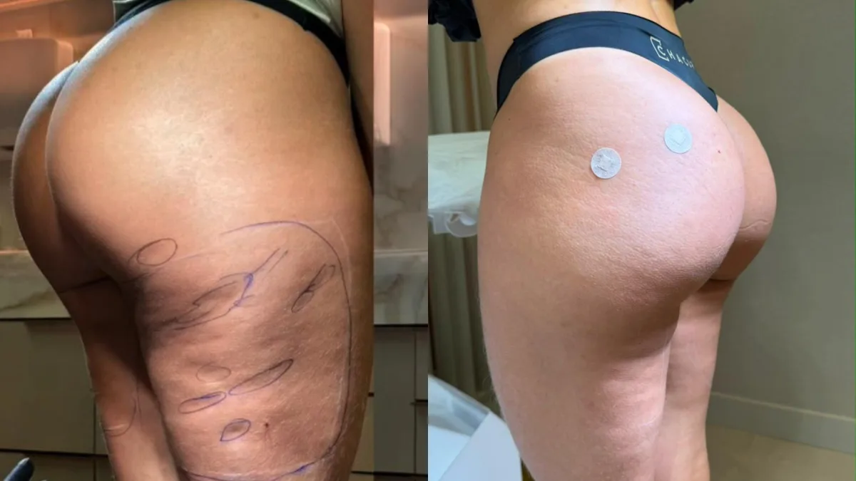 Ex-BBB Isabelle Nogueira mostra resultado de harmonização nos glúteos; veja antes e depois Ex-BBB Isabelle Nogueira mostra resultado de harmonização nos glúteos; veja antes e depois